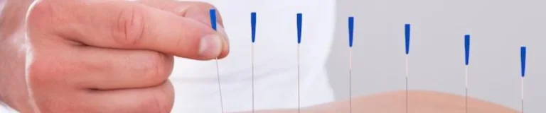 Dry Needling Therapy